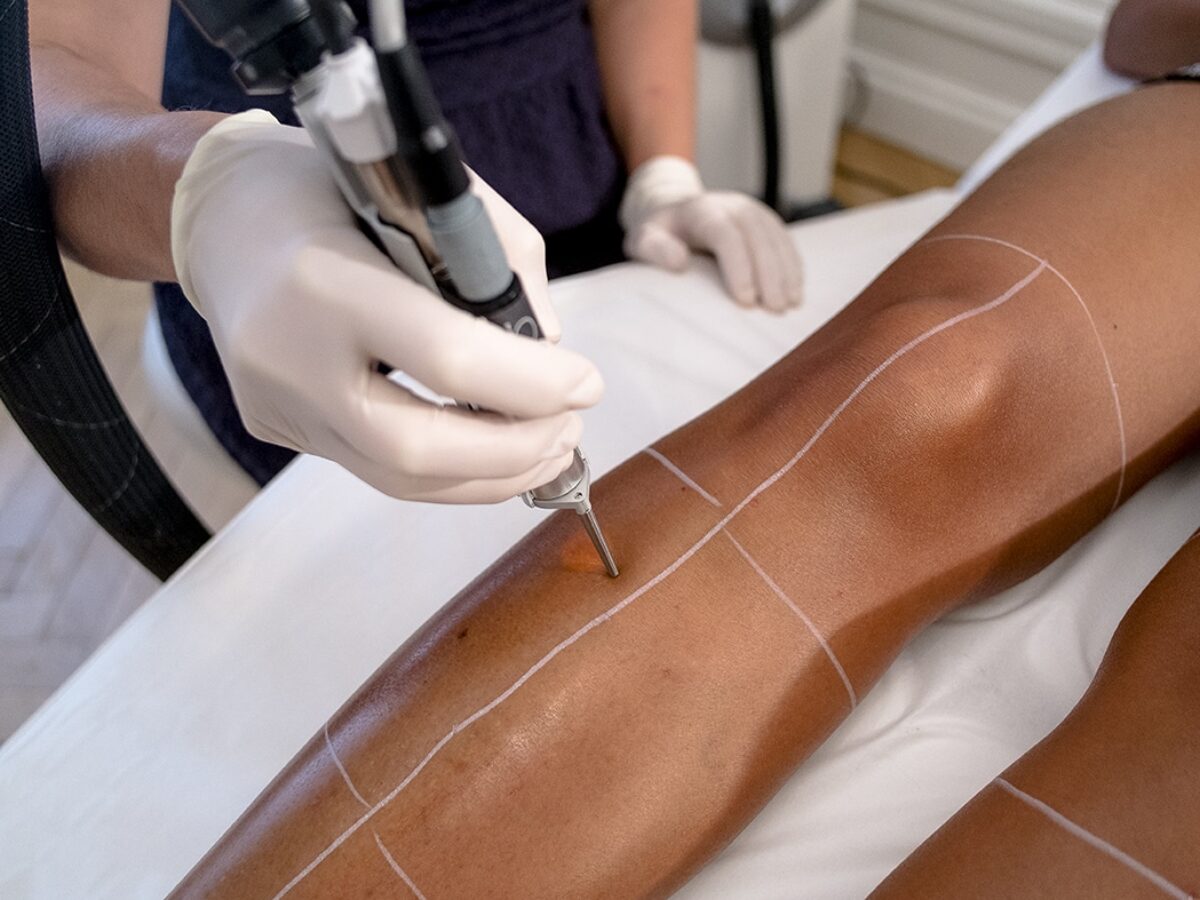 Centre Lyon : Épilation laser pour les peaux mates et les peaux noires
