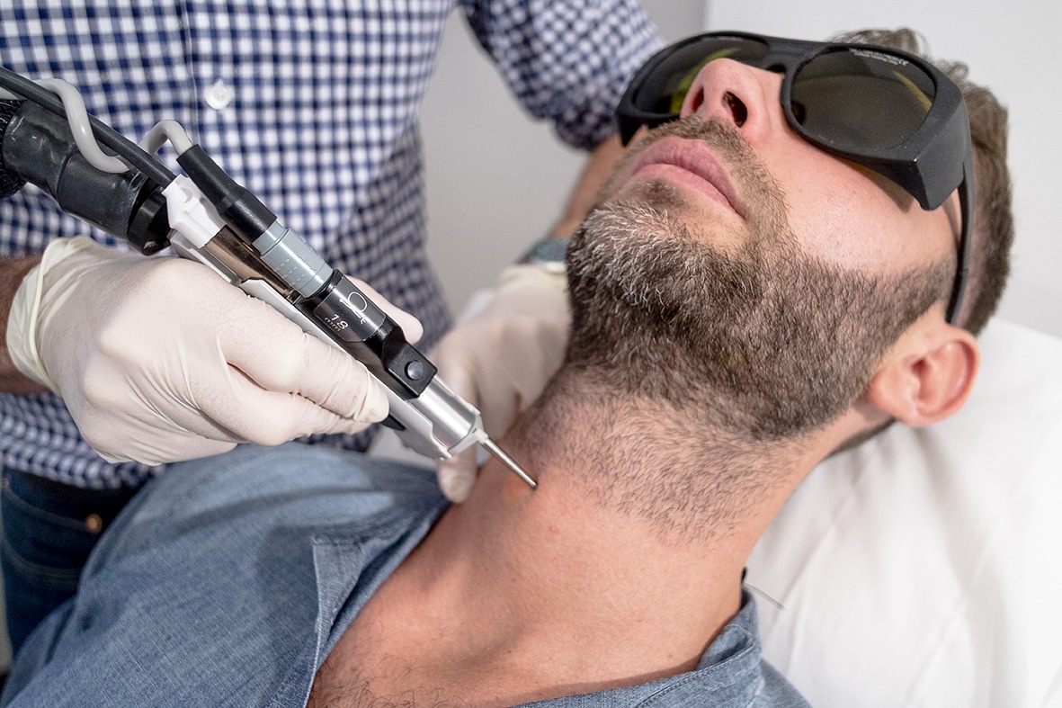 Traitement épilation laser homme de la barbe
