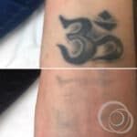 Détatouage : Effacez un tatouage au laser