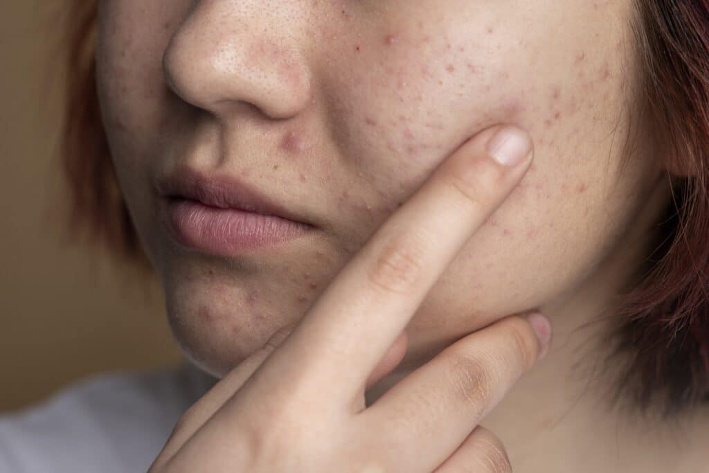 cicatrices d'acné