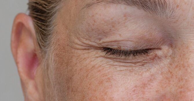 Taches pigmentaires : pourquoi apparaissent-elles et peut-on toutes les traiter ?